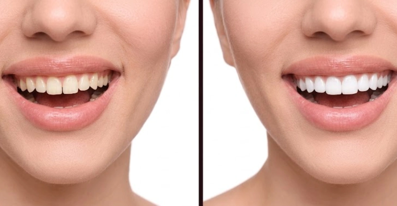 Gum Contouring vs Crown Lengthening1